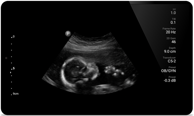 Resultaten van echografieonderzoek