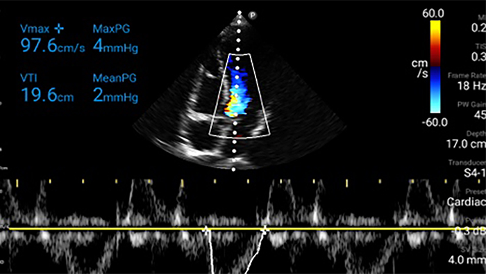 Thumbnail hartdiagram